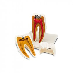 Enlarged model of molar tooth B23